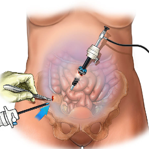 Laparoscopic Surgery in Goregaon